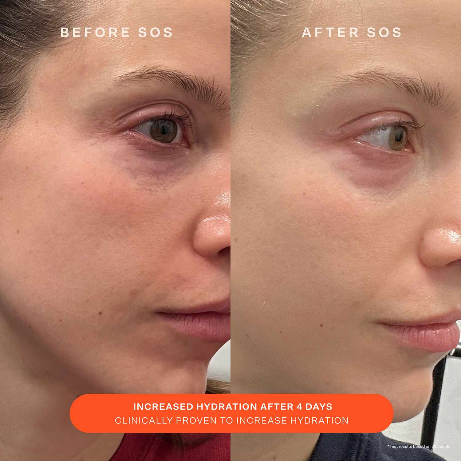Pele facial antes e depois de usar o creme de creme de recuperação diário de barreira SOS