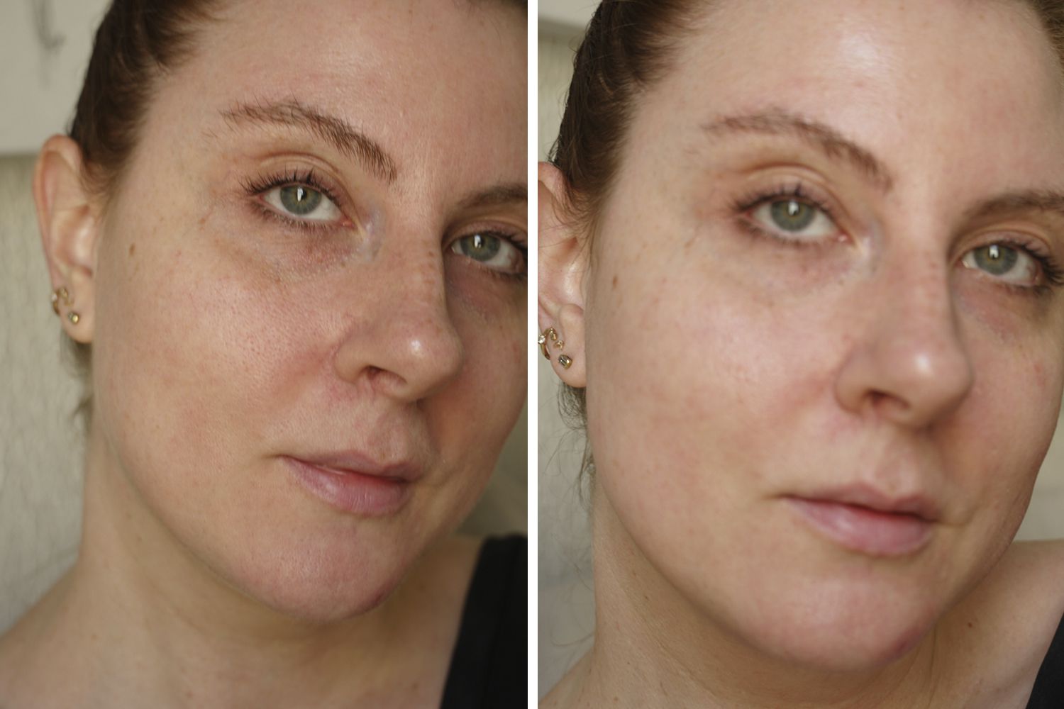 Face humana antes e depois de usar a essência da dermalogia neogênica real micro essência