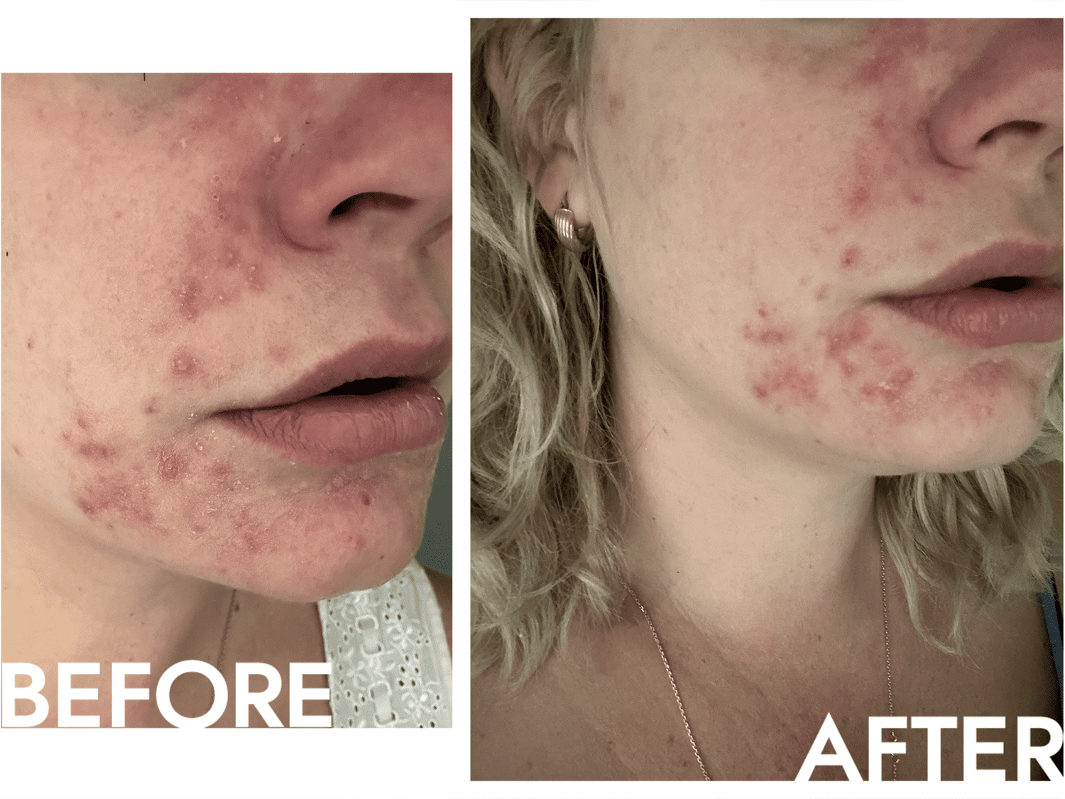 Antes e depois de aplicar as soluções verdadeiramente direcionadas da acne do Kiehl