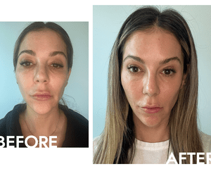 Fotos antes e depois de usar o soro com vitamina C do escritor de Corave Byrdie Eliza Tabin