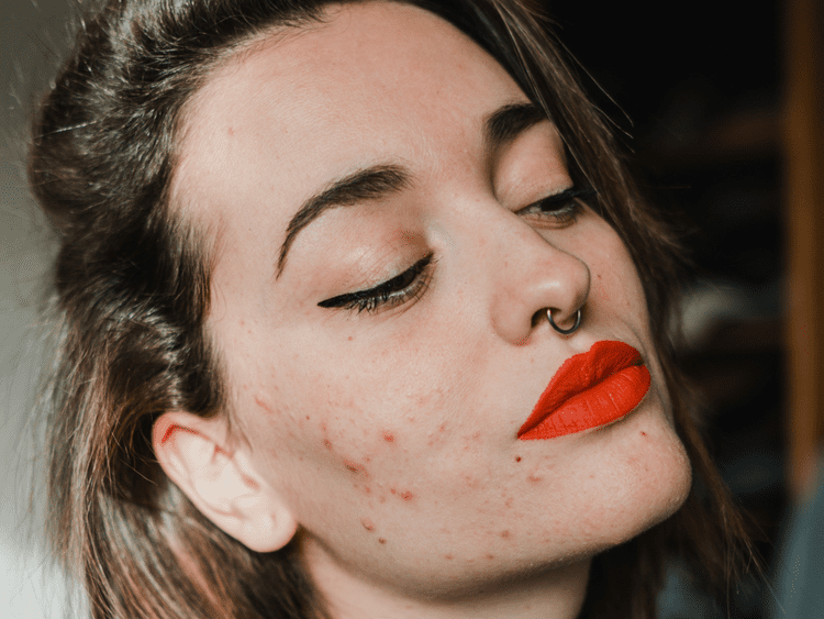 Um modelo com um rosto em close com acne inflamatória nas bochechas, mandíbulas e queixo, pintada com batom vermelho brilhante.