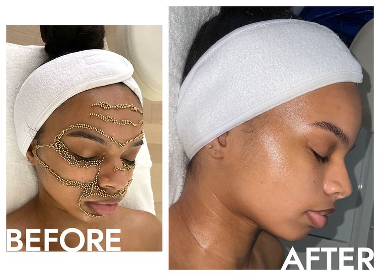 Qi Beauty Facial antes e depois